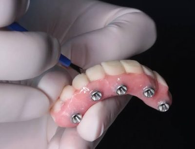 implant prosthetics implant prosthetics